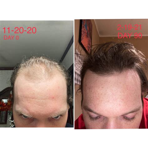 Minoxidil Results