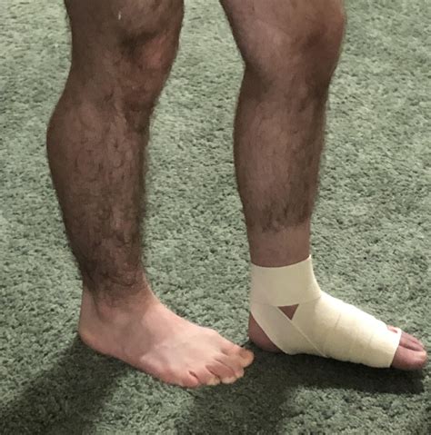 I have a Lisfranc fracture involving three metatarsals. It’s made me so