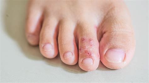 tinea pedis prevalence  children varies widely
