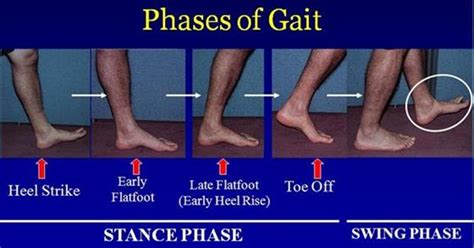 Symptom finder - The causes of gait abnormalities - Medical Zone