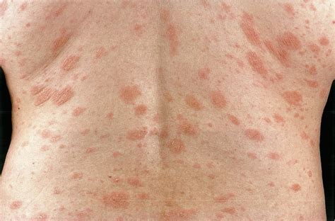 Christmas Tree Rash Pityriasis Rosea at Dane Wallace blog