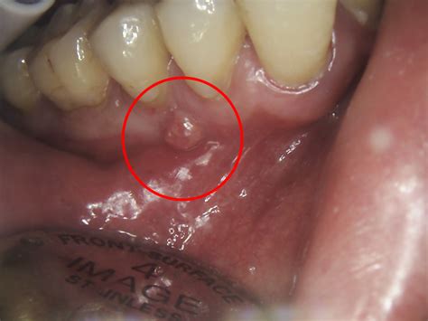 Tooth Abscess Stages: Pictures and Treatment Options - Web DMD