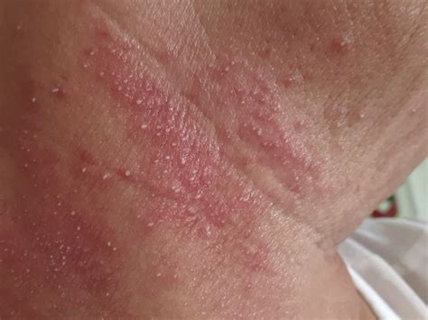 Histopathology of cutaneous COVID-19 lesion: possible SARS-CoV-2 ...