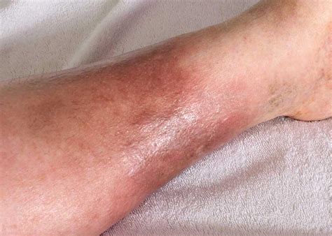 Cellulitis Treatment: Antibiotic Cream, Cellulitis Treatment at Home
