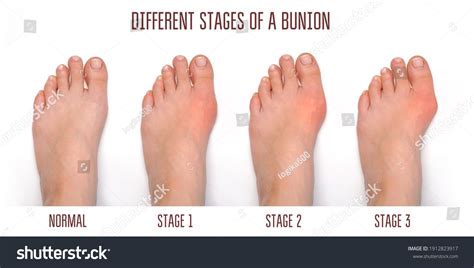 bunion  young age  william noland blog