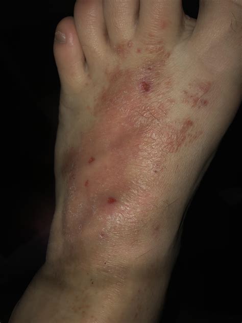 Is this athletes foot? I work 12 hour shifts and and on my feet all