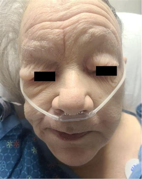 Periorbital Edema Hypothyroidism
