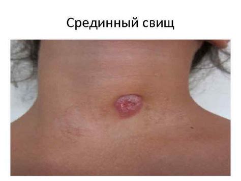 Врожденные кисты и свищи шеи Выполнил Доможаков В