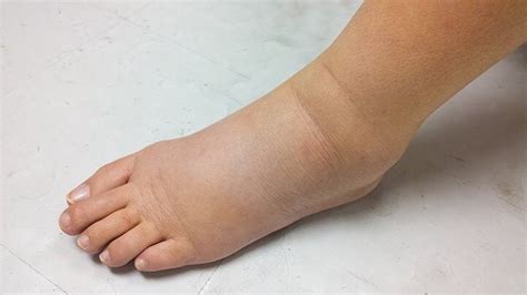 Edema: qué es, síntomas y tratamiento | Top Doctors
