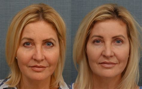 Upper Eyelid Blepharoplasty Archives - Page 2 of 8 - Jeffrey M. Joseph