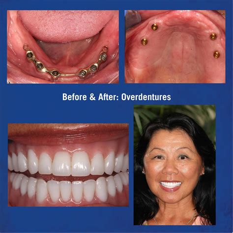 dental implants  implant dentures  bessie humble blog