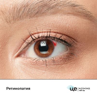 Болезнь Ретинопатия: о заболевании – Це Клініка