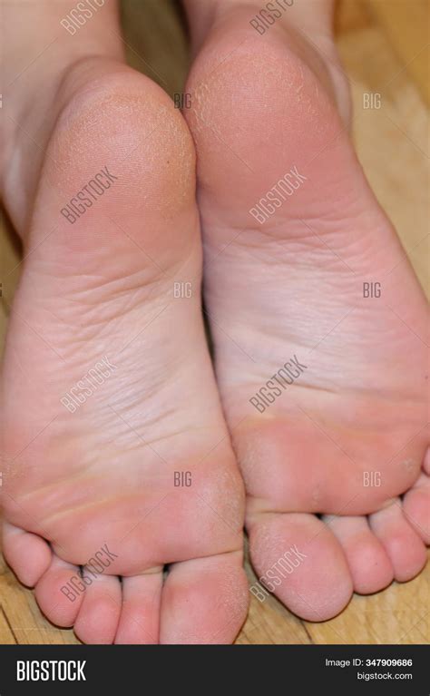 dry cracked feet image photo  trial bigstock