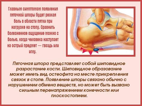 Шпоры в пятках: лечение в домашних условиях