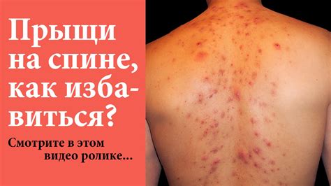 Прыщи на спине Как избавиться? 4 НАДЕЖНЫХ способа! Смотри в этом видео ...