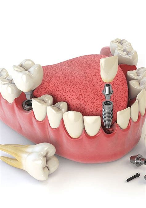 Implanti | DENTALWORLD