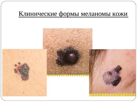 Опухоли кожи - презентация онлайн