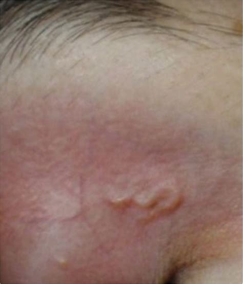Human Dirofilariasis in Bulgaria Between 2009 and 2018 - PMC