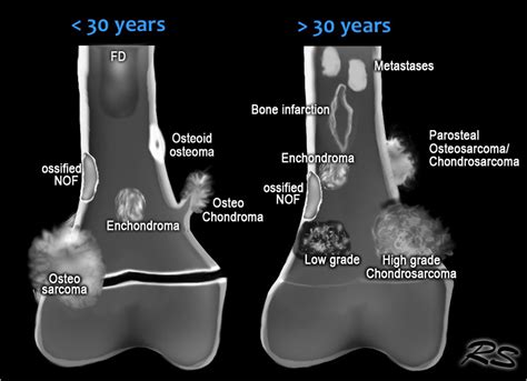 The Radiology Assistant : Bone - Sclerotic tumors and tumor-like lesions