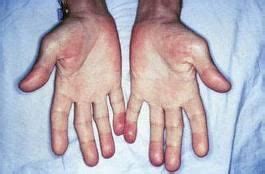 oslers nodes usmle forums