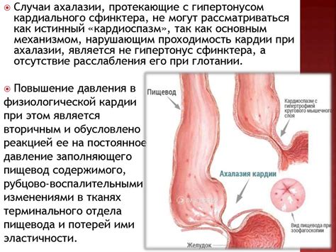 Ахалазия кардии (кардиоспазм) - презентация онлайн