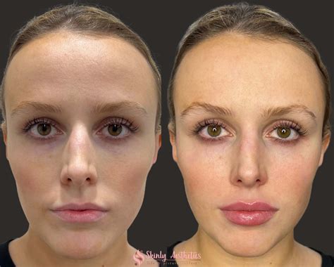 Lip Injections Before And After Juvederm