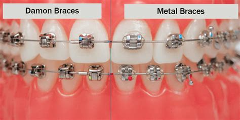 Different Types of Orthodontic Brackets - Dr Jamilian