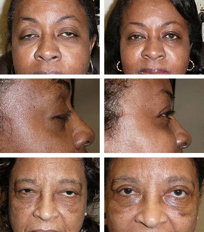 Eyelid Surgery Broward County FL | Hollywood Eye Institute