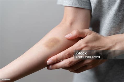 bruise  asian woman arm close  stock photo  image