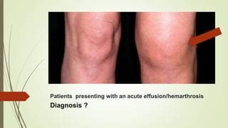 management  acute hemarthrosis  hemophilia including