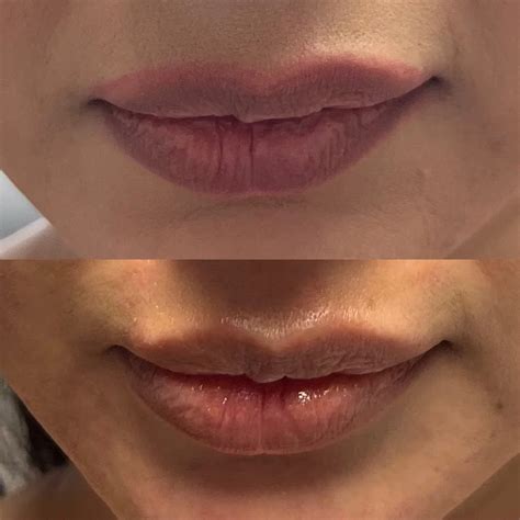 lip laser     laser treatments