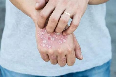 Coceira Nas Mãos E Nos Pés - Coceira por Estresse nas Mãos e nos PÉS - Causas e Tratamento