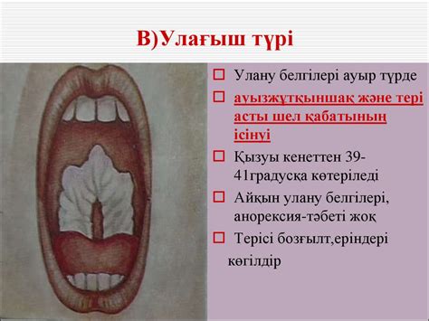 Балалар жұқпалы аурулары - презентация онлайн