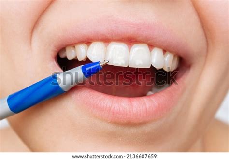 15,023 White Spots In Mouth Images, Stock Photos & Vectors | Shutterstock