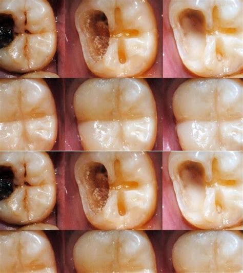 how to remove cavity at home