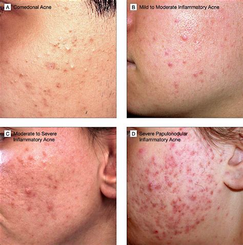 Acne Rosacea Vs Acne Vulgaris