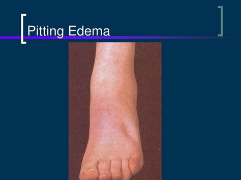 PPT - Sodium and Water Assessment PowerPoint Presentation, free