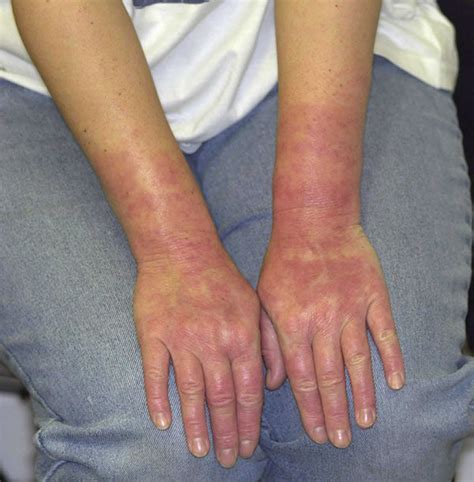 Contact Dermatitis Gloves at Reva Forbes blog