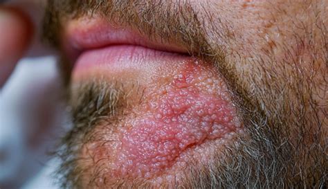 tinea barbae md searchlight