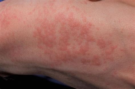 Heat rash (prickly heat) | nidirect