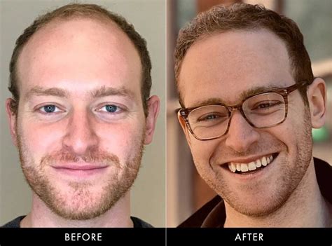 hair restoration barber surgeons guild