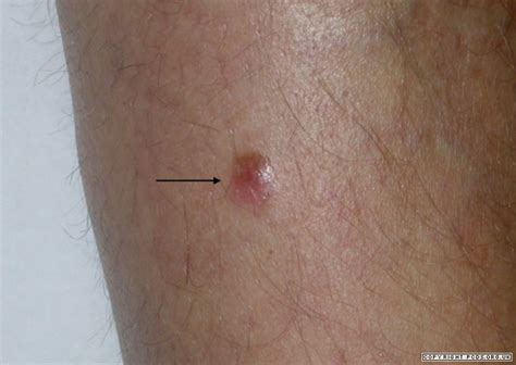 Melanoma - South East Skin Clinic