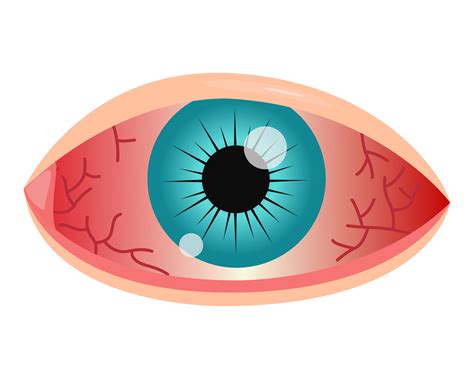 how to soothe a scratched eye 4