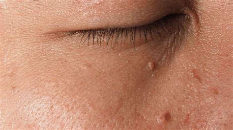 white warts  face identifying  common red spots  skin