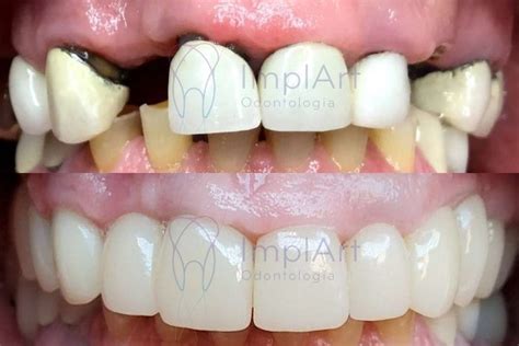 Fotos De Implantes Dentários Antes E Depois - Implantes dentário antes e depois é Surpreendente