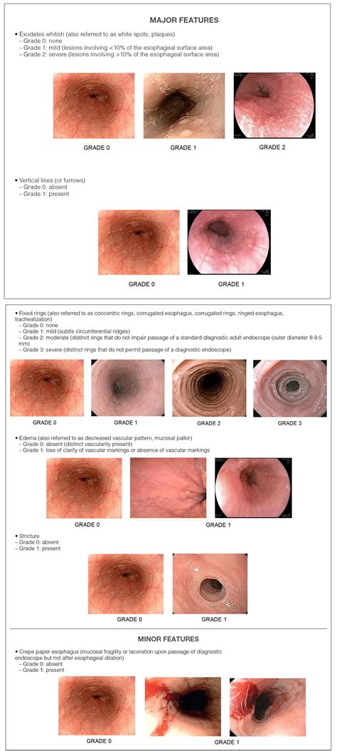 Esophagitis Eosinophilic Treatment at Susan Villanueva blog