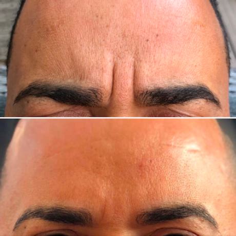 Botox fronsrimpel bij De Botoxspecialist