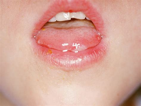Red Spots On Lips Child | Lipstutorial.org
