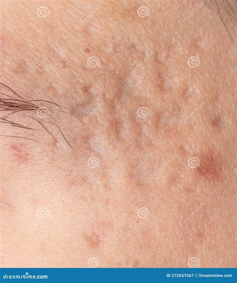 Acne Scars on the Skin. Macro Stock Image - Image of blemish, healthy