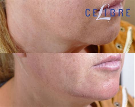Radiesse Before and After Pictures